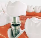 dental-implant-1